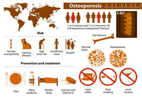 Bone density: what do we need to know about Osteoporosis ...