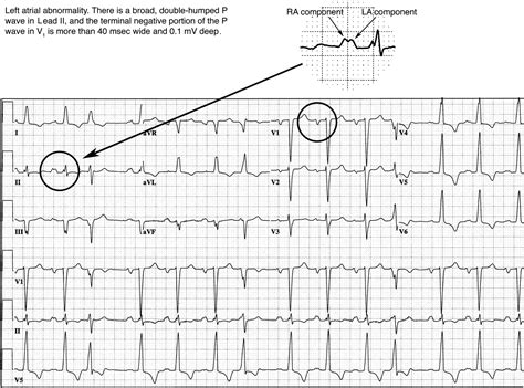 Chamber Abnormalities and Intraventricular Conduction Defects | ECG in ...