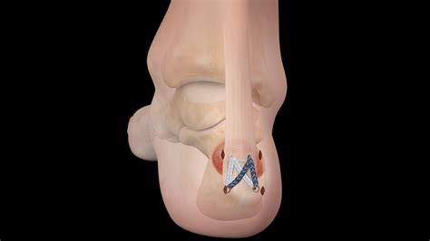 Arthrex - MIS Percutaneous Achilles SpeedBridge™ Surgical Technique