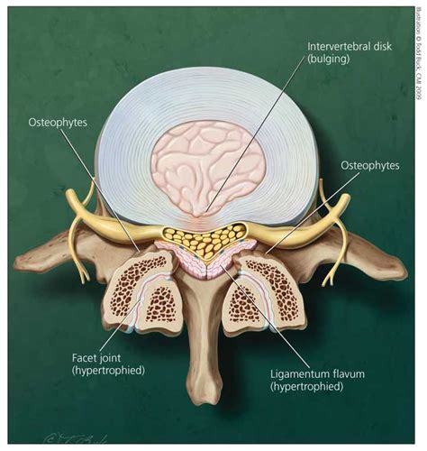 Ligamentum Flavum Anatomy - Human Anatomy