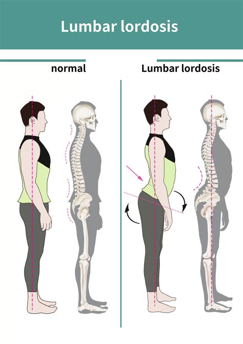 Lumbar Lordosis: Definition, Causes, Symptoms, Diagnosis, and Treatment ...