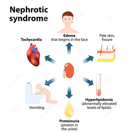 Prepare for Medical Exams : Causes Of Nephrotic Syndrome