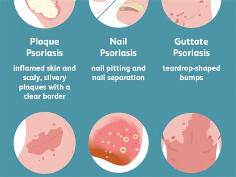 Psoriasis - Signs, Symptoms, And Treatments - No. 9 Restaurant Millerton