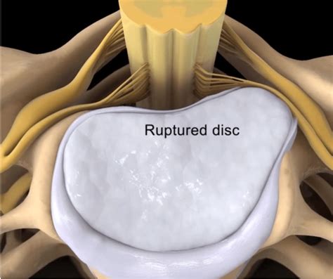 How to relieve lower back pain from herniated disc.