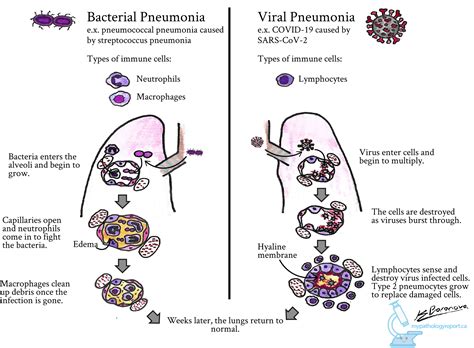 Pneumonia - MyPathologyReport.ca