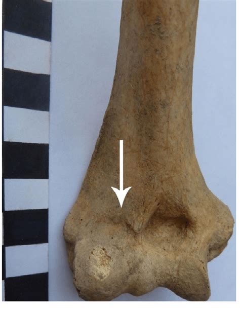 Radial fossa on the distal end of the humerus. | Download Scientific ...