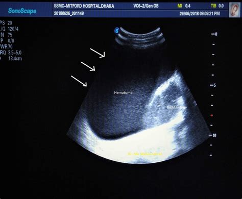 Case 07: Retroperitoneal Hematoma Ultrasound