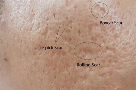 Acne Scars: Types of Acne Scarring and Ideal Treatments