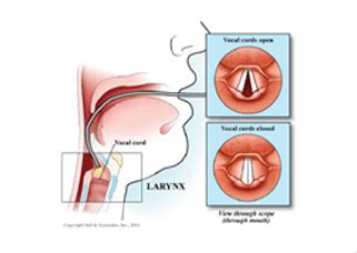 Vocal Cord Paralysis - Symptoms, Causes & Treatment