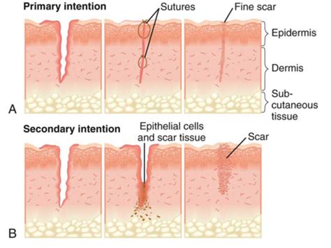 W5: Skin Integrity Flashcards | Quizlet