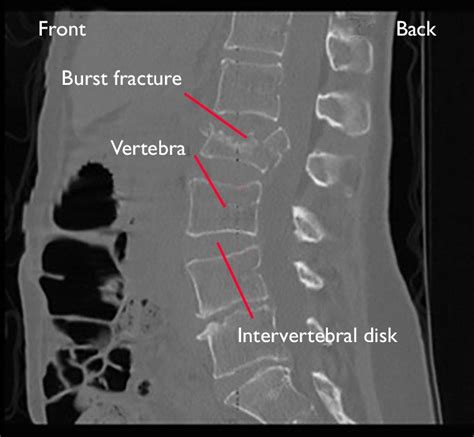 Fractures of the Thoracic and Lumbar Spine - OrthoInfo - AAOS