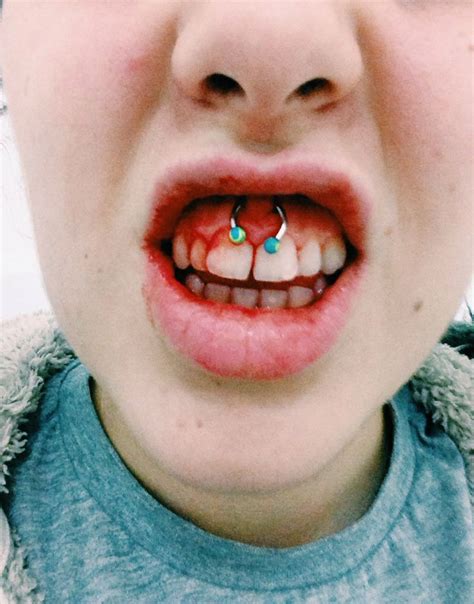 Smiley Piercing Infection images