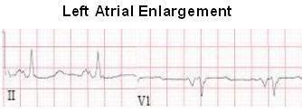 Left Atrial Enlargement (LAE) ECG Review | Learn the Heart