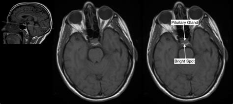 Pituitary Gland Mri Anatomy