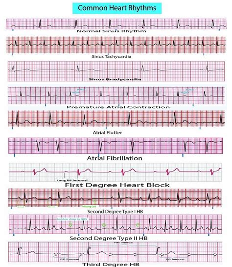 Common Heart Rhythms: A Comprehensive Guide