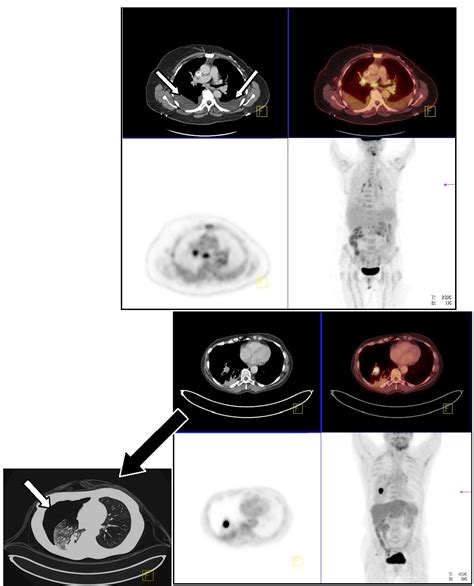 Positron Emission Tomography-Computed Tomography Data Acquisition and ...