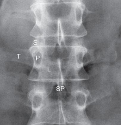 Lumbar Spine Anatomy - Spine - Orthobullets