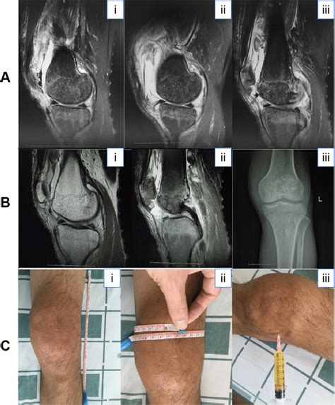 Bone Marrow Femur Mri