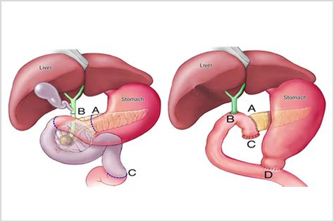 Surgery: Whipple Procedure - Let's Win Pancreatic Cancer