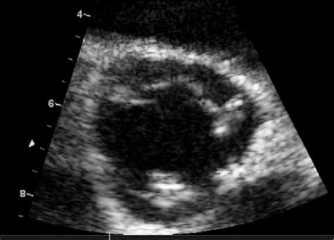 -Short axis view of trileaflet aortic valve with mobile vegetations ...