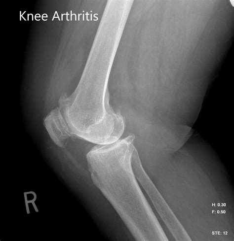 Normal Knee Anatomy