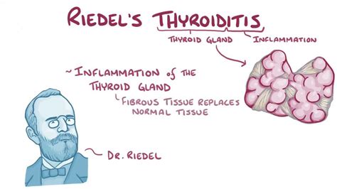 Tiroiditis de Riedel: Vídeo, Anatomía & Definición | Osmosis