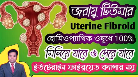 Uterine fibroid homoeopathic medicine | fibroid tumor homoeopathic ...