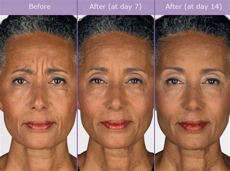 Botox Before After Photos | Wrinkle Remover Dallas, Plano, Texas