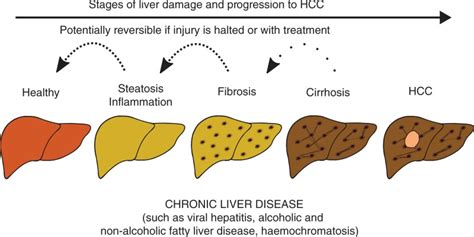 Acute Liver Failure