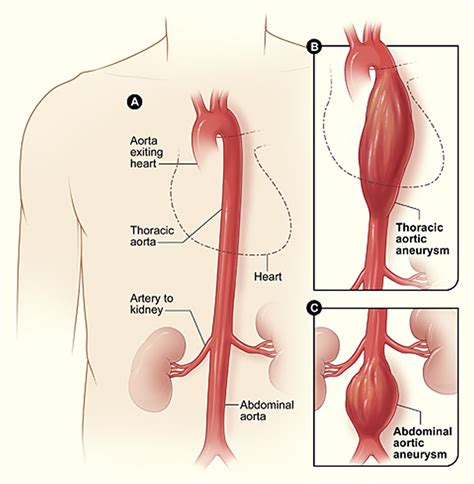 Aortic Aneurysm - Abdominal & Thoracic - Causes, Symptoms, Repair