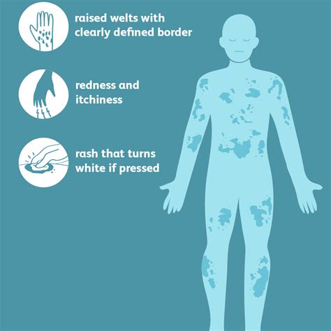 Urticaria (Hives): Signs, Symptoms, and Complications