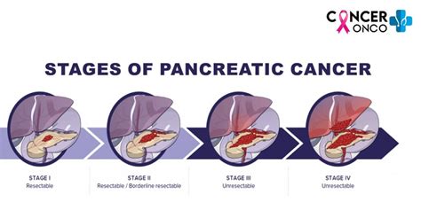 Pancreatic Cancer Treatment and Its 5 Stages