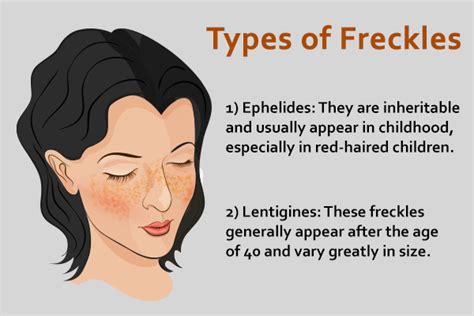 Exploring The Differences Between Freckles And Lentigines: A ...