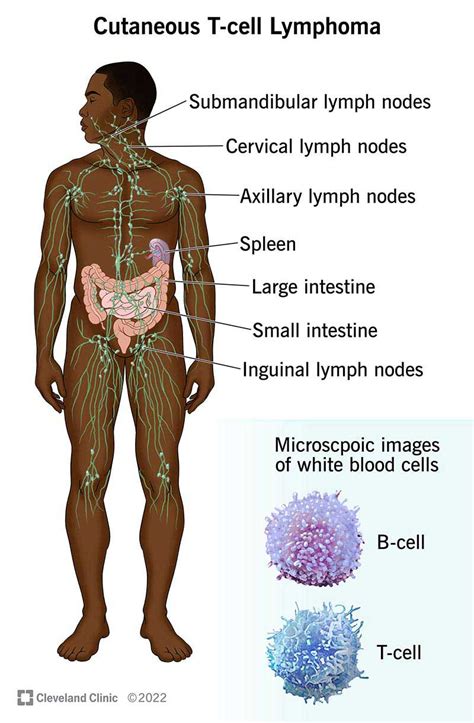 Cutaneous T-Cell Lymphoma (CTCL)