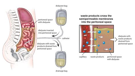 Peritoneal Dialysis related Peritonitis