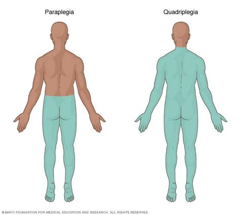 Spinal cord injury - Symptoms and causes | Auxiliar de enfermeria ...