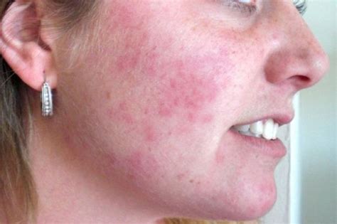 A Symptom of sensitivity | Face rash remedies, Rashes remedies, Rash on ...