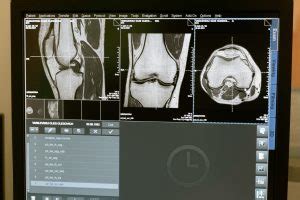 What is bone marrow edema? Causes and treatment - Richard Troy