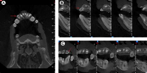 CBCT images. A: Axial view, B: Sagittal view, C: Coronal view. The ...