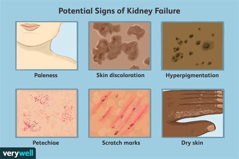 Kidney Failure Symptoms, Causes, Treatment And Remedies Axe, 54% OFF