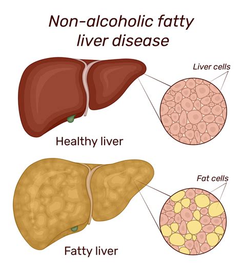 What is Fatty Liver Disease? | GI Associates