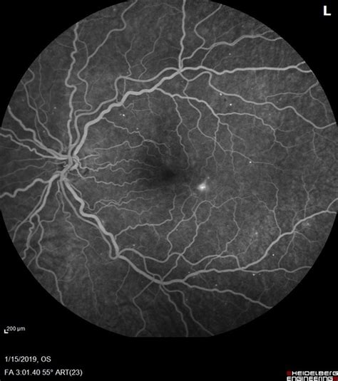 Mild Nonproliferative Diabetic Retinopathy - Retina Image Bank