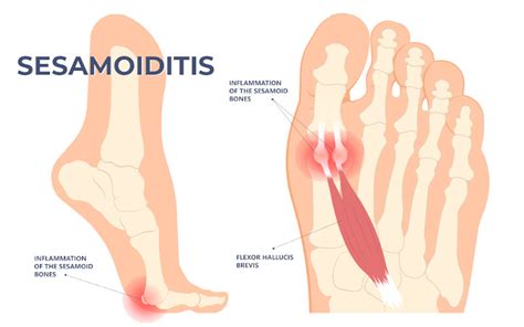 How to deal with issues with the sesamoid bone in the Foot