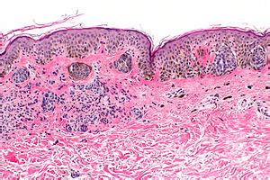 Congenital Melanocytic Nevus Histology