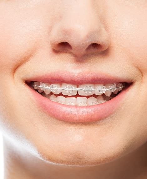 Six Month Smiles Henderson, NV | Braces | Dental Excellence: Dr. Brett ...