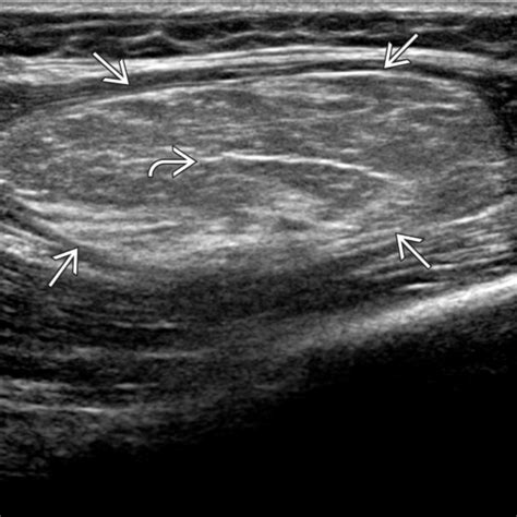 Lipoma | Radiology Key