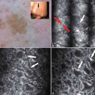 (PDF) In vivo Analysis of Solar Lentigines by Reflectance Confocal ...