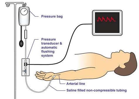 Arterial line | Nursing School!!!:) | Pinterest