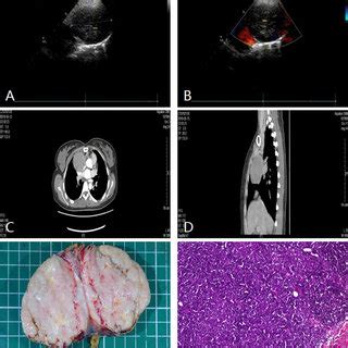 Anterior mediastinal mass (teratoma) in a 59-year-old man. A and B TTE ...