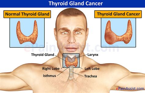 Thyroid Gland Cancer|Causes|Symptoms|Treatment-Surgery, Harmone ...